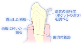 歯周病について