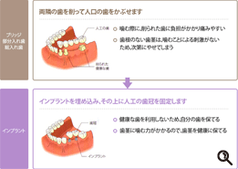 隣接する歯を1,2本失った場合